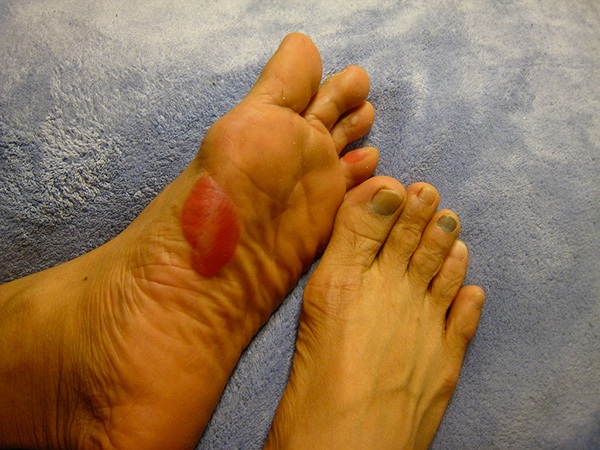 black toenails