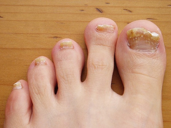 toenail fungus symptoms