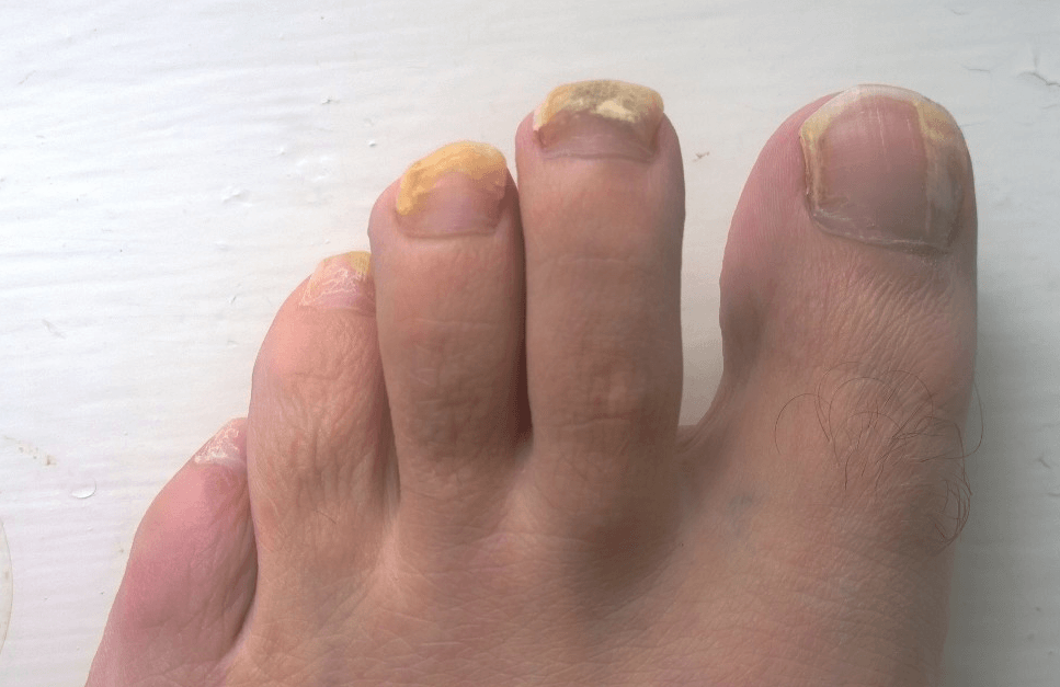 7 Ways To Treat Brittle Toenails Toenail Fungus Tips