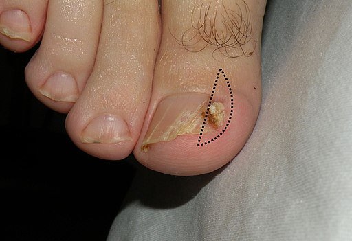 ingrown toenail 
