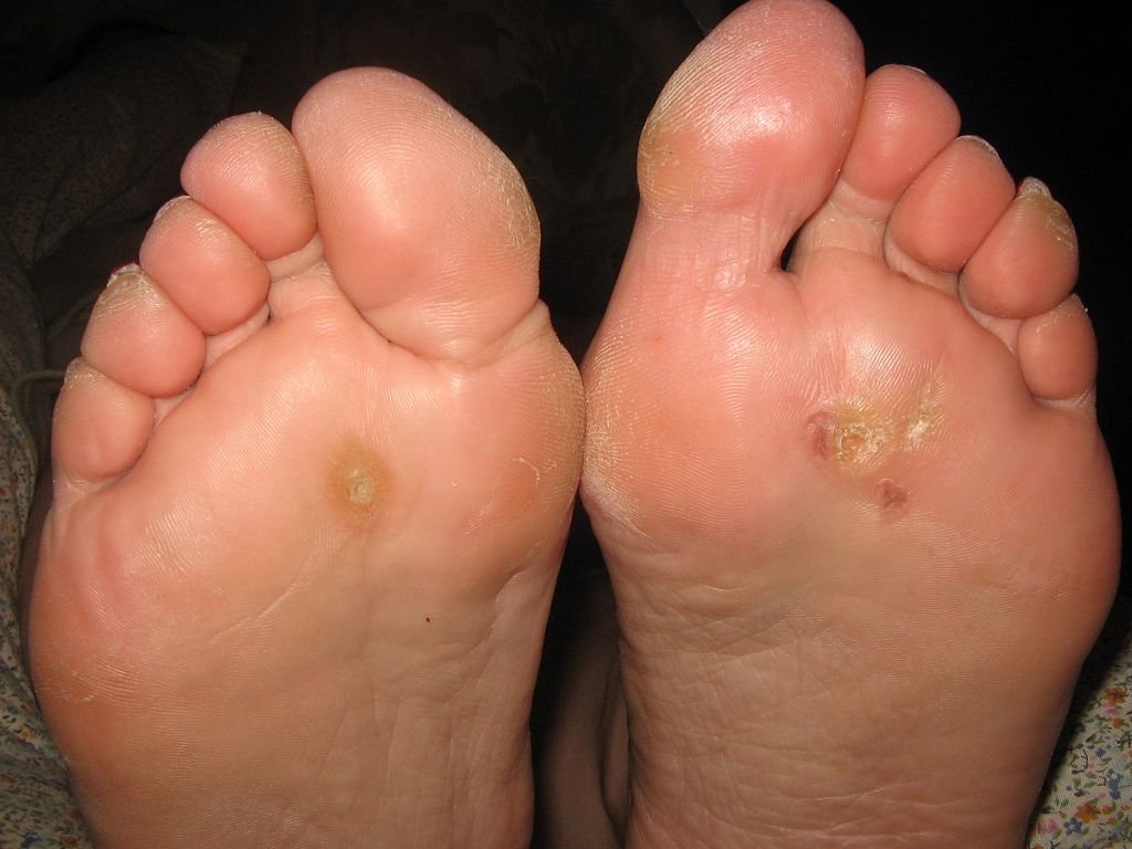what is a plantar wart