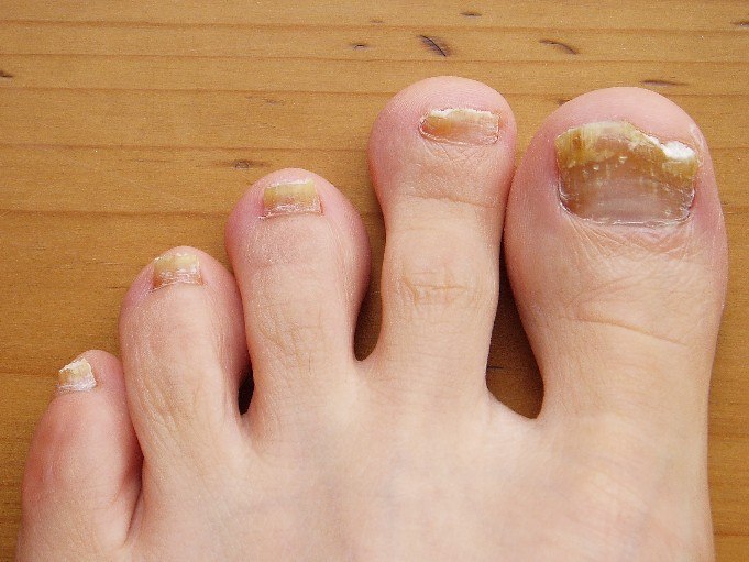 is toenail fungus dangerous