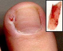 toenail removal aftercare