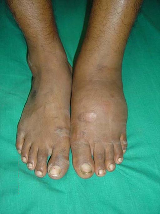 what is charcot foot