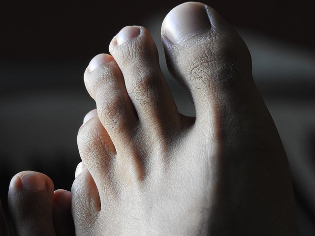 what causes capsulitis of the second toe